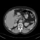 Adrenal adenoma, delayed: CT - Computed tomography